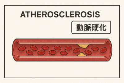 脂質異常症と慢性腎臓病の危険な関係──動脈硬化による合併症に要注意のアイキャッチ画像